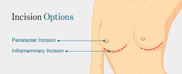Incision Options