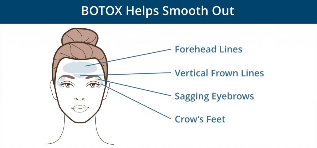 BOTOX helps smooth out forehead lines, vertical frown lines, sagging eyebrows, and crow's feet.