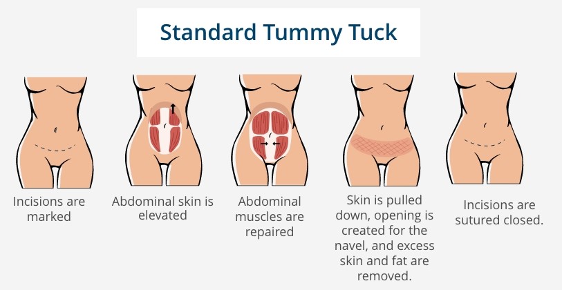 standard tummy tuck infographic