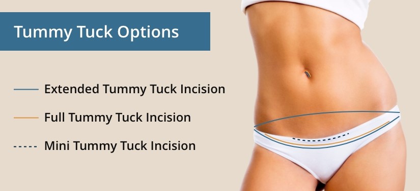 tummy tuck options infographic