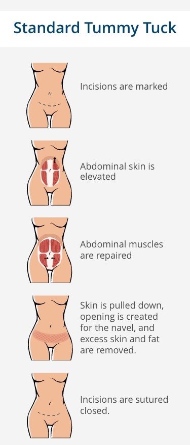 standard tummy tuck infopgrahic