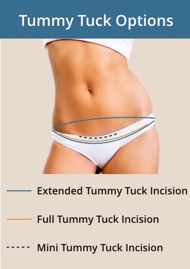 tummy tuck options infographic