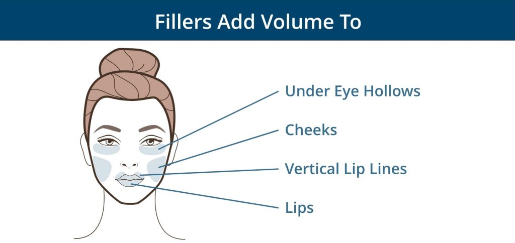 Fillers add volume to under eye hollows, cheeks, vertical lip lines, and lips.