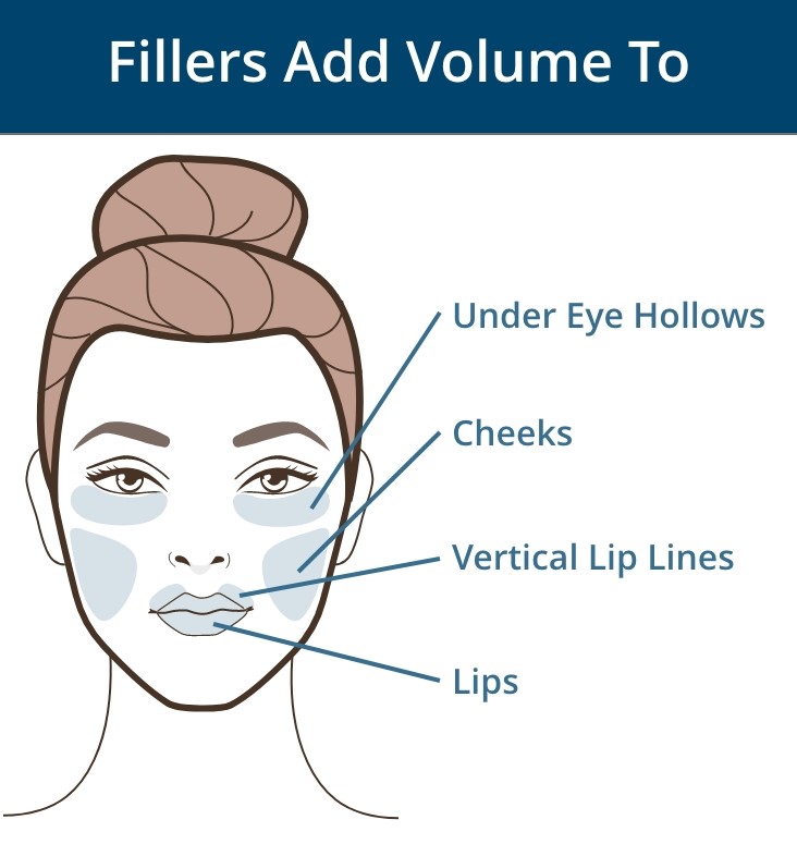Fillers add volume to under eye hollows, cheeks, vertical lip lines, and lips.
