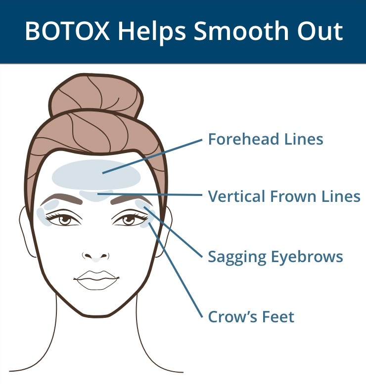 BOTOX helps smooth out forehead lines, vertical frown lines, sagging eyebrows, and crow's feet.